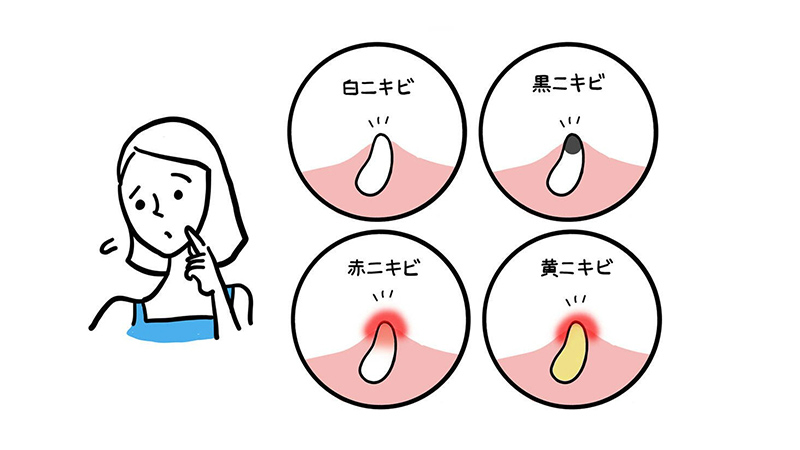 白ニキビ、黒ニキビ、赤ニキビ、黄ニキビ