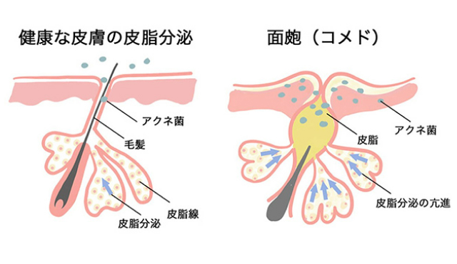 健康な皮膚の皮脂分泌、面皰（コメド）