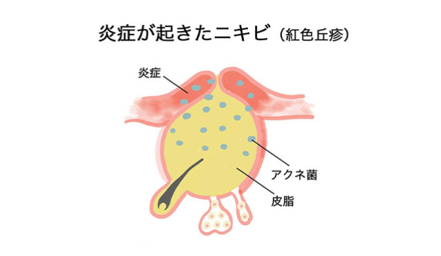 炎症が起きたニキビ