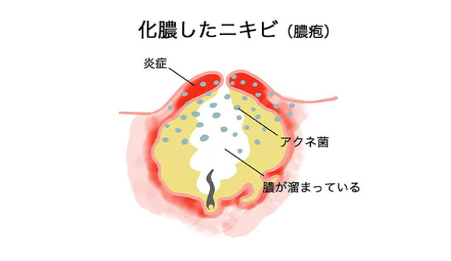 化膿したニキビ