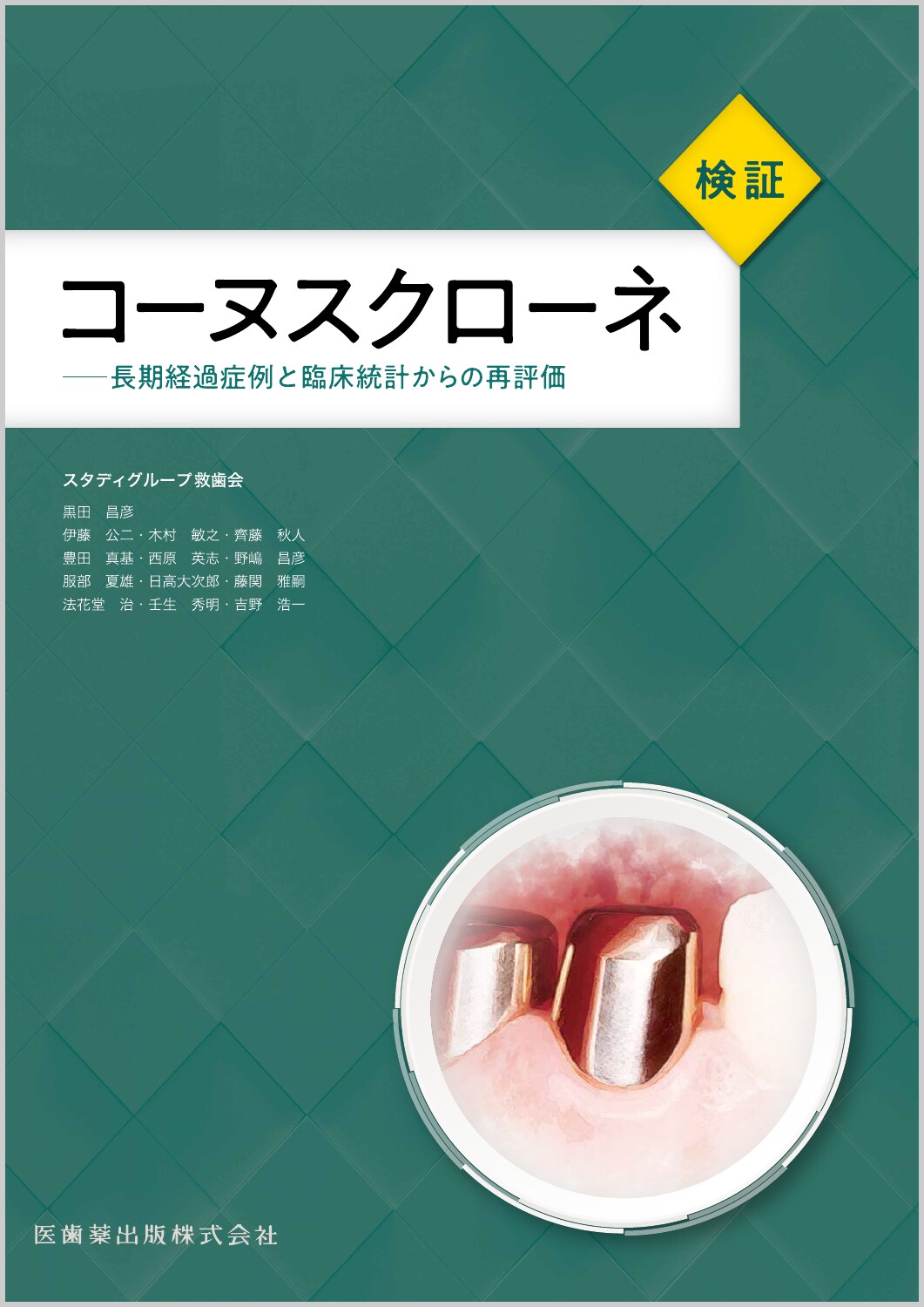 検証コーヌスクローネ 長期経過症例と臨床統計からの再評価/医歯薬出版/スタディグループ救歯会