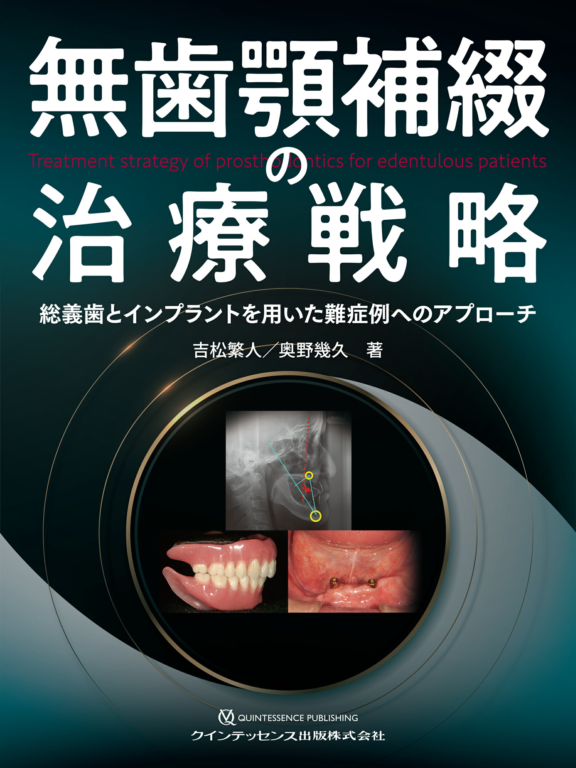 埋伏歯の保存治療ストラテジー : 誘導・牽引のタイミングと