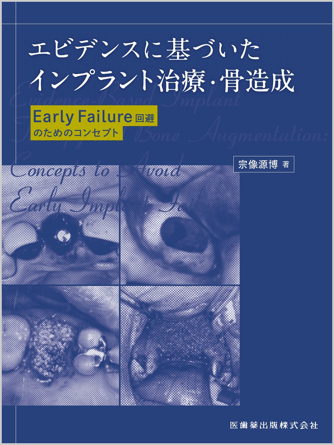 エビデンスに基づいたインプラント治療・骨造成 Ｅａｒｌｙ　Ｆａｉｌｕｒｅ回避のためのコンセプト/医歯薬出版/宗像源博