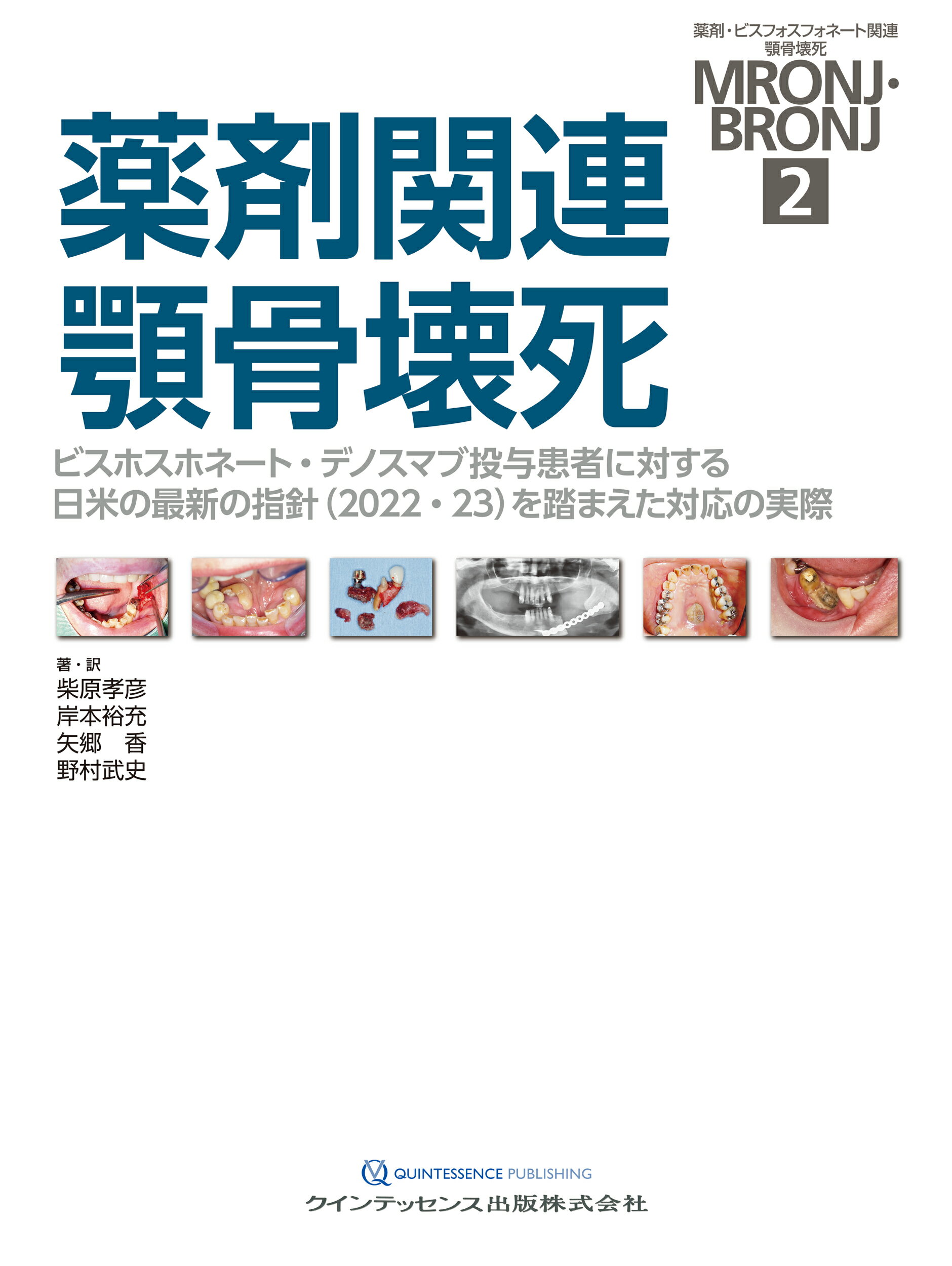 薬剤関連顎骨壊死 ビスホスホネート・デノスマブ投与患者に対する日米の/クインテッセンス出版/柴原孝彦