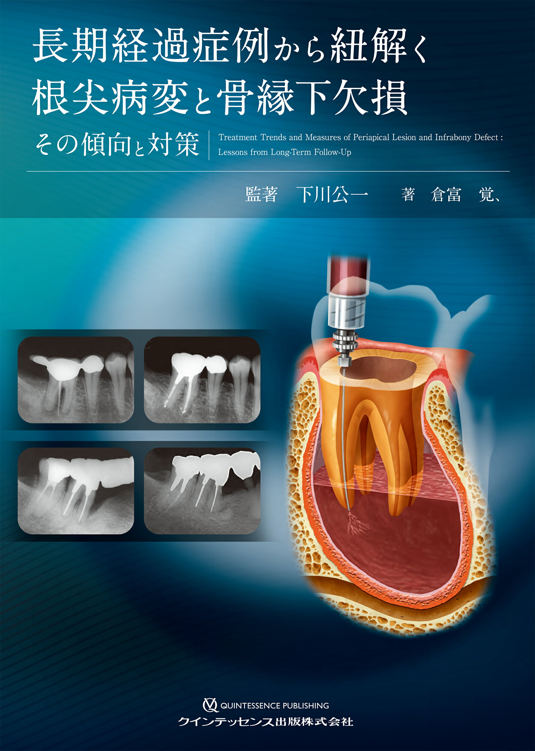 エンドに必要なアナトミー 根管の構造と機能に基づく実践歯内治療 健康