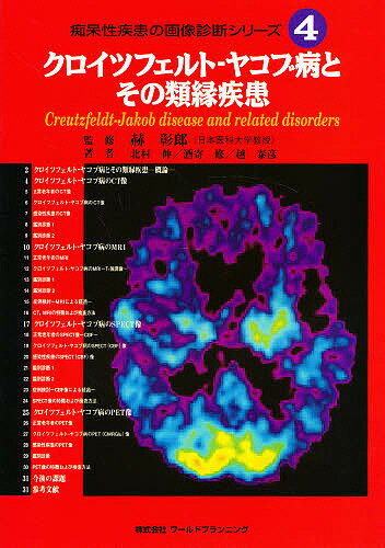 ヤコブ クロイツ 病 フェルト プリオン病のMRI画像診断の注意点