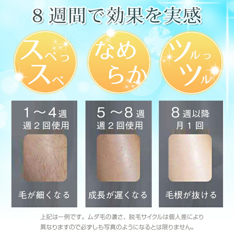 IPL光冷却脱毛 フラッシュ脱毛 Hikari